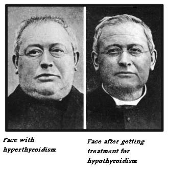 Thyroid Treatment For Men