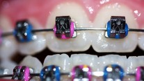 How to Choose the Color of your Braces