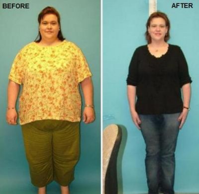 How to Decide on Gastric Bypass Surgery to Lose Weight