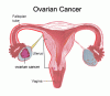 Ovarian cancer