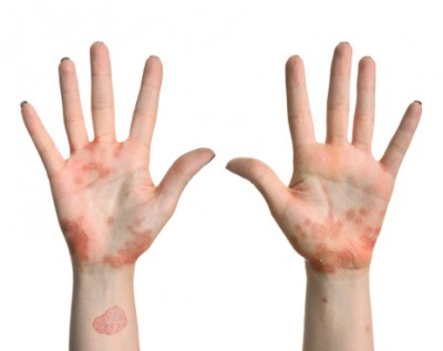 How to Stop Eczema Flare Ups