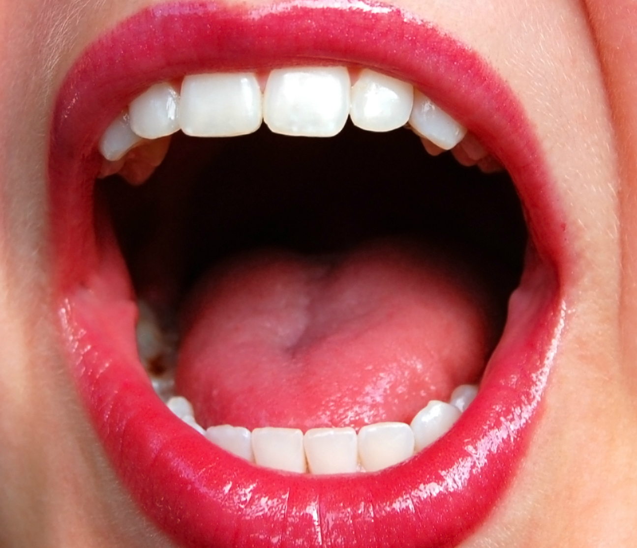 How To Cure And Prevent Mouth Ulcers